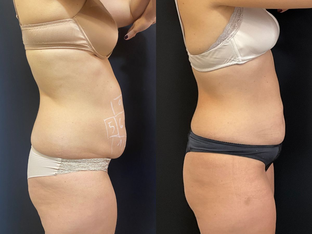 Antes e depois de tratamento para gordura localizada no abdômen