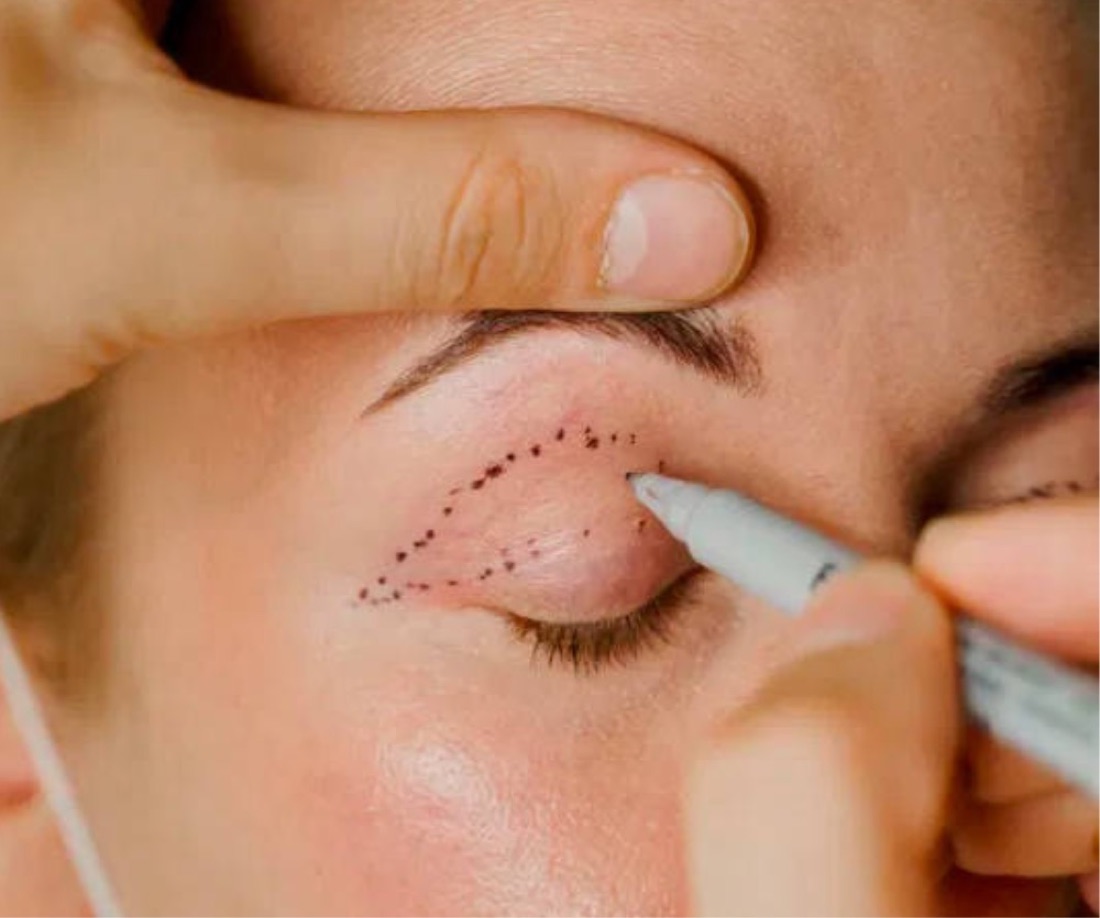 Blefaroplastia sem Cortes — Clínica Carina Borges