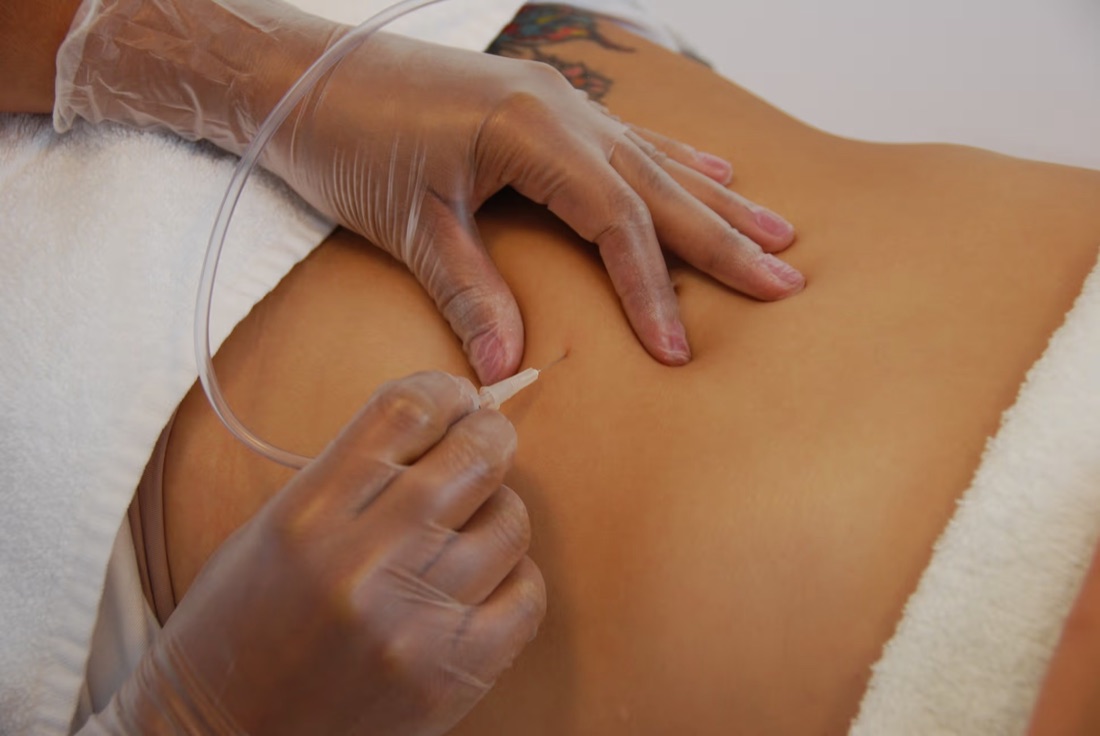 Carboxiterapia — Clínica Carina Borges
