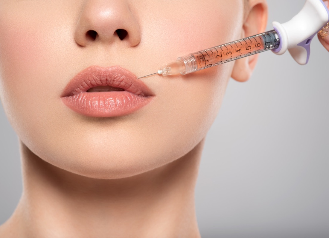 Preenchimento Labial — Clínica Carina Borges