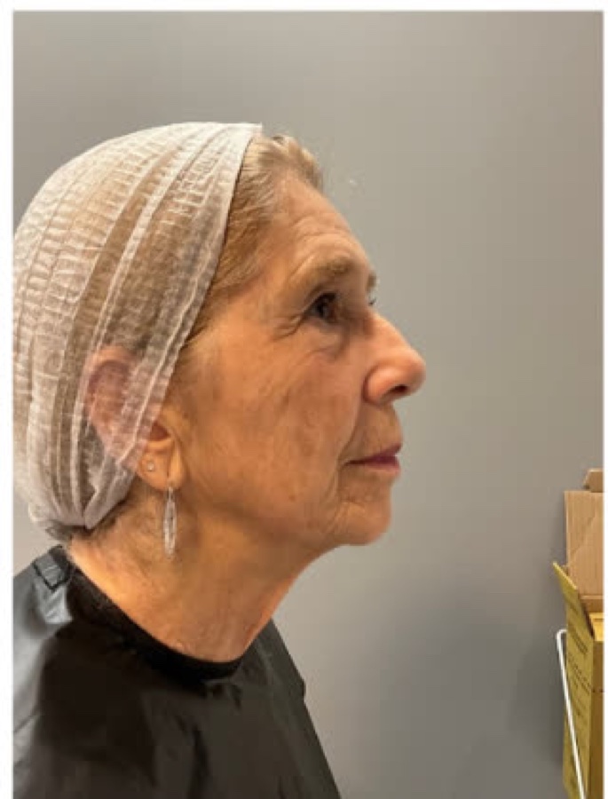 Harmonização Facial — antes