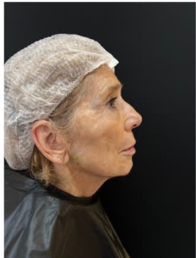 Harmonização Facial — depois