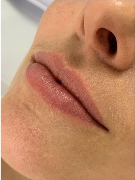 Preenchimento Labial — antes